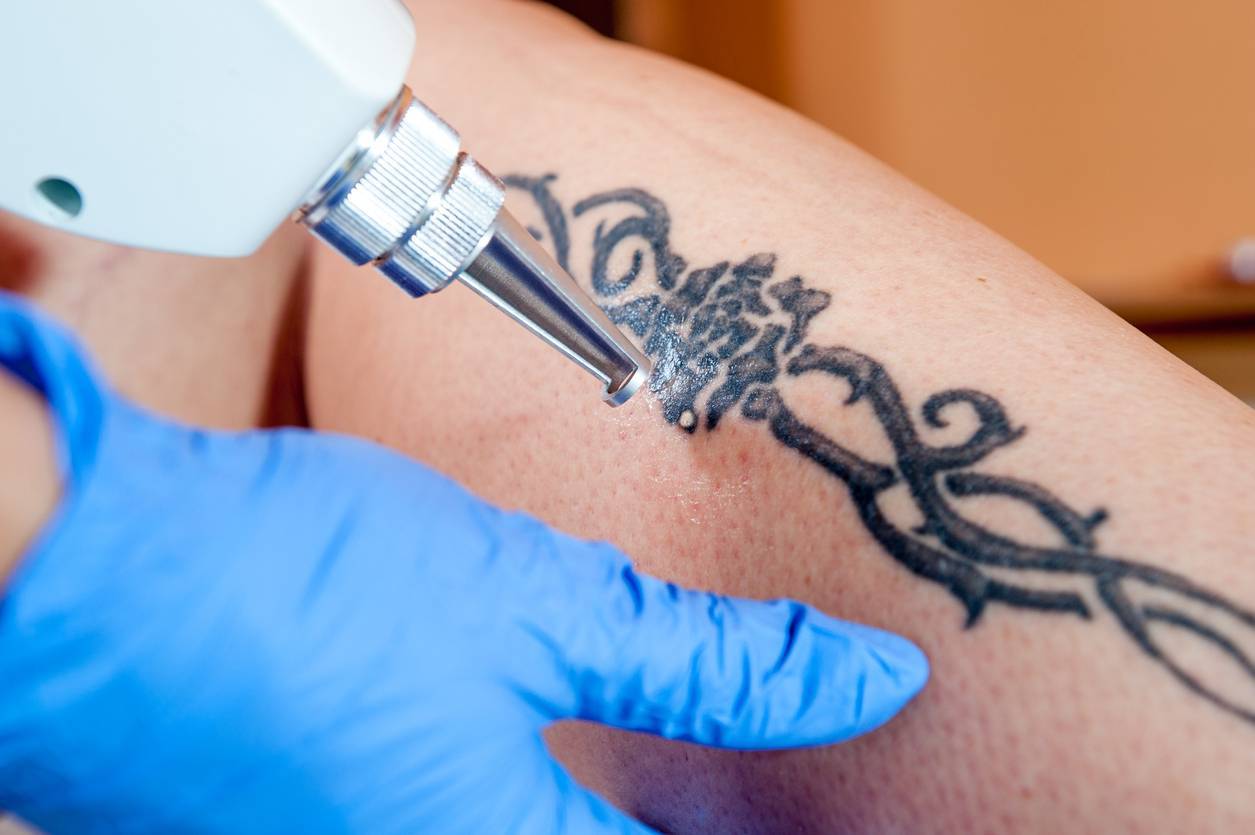 Ablauf der Sitzung zur Tattooentfernung