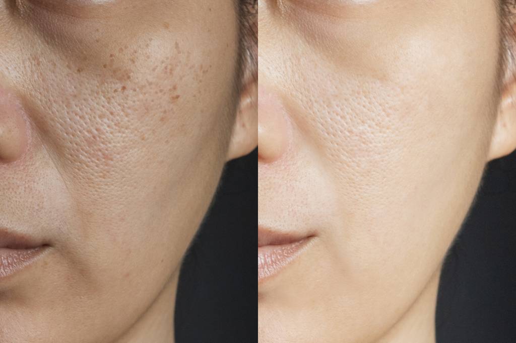 Serum erweiterte Poren schöne Haut